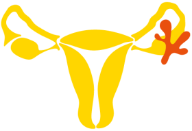 Centrum pro nádory vaječníků, tuby a&nbsp;peritonea